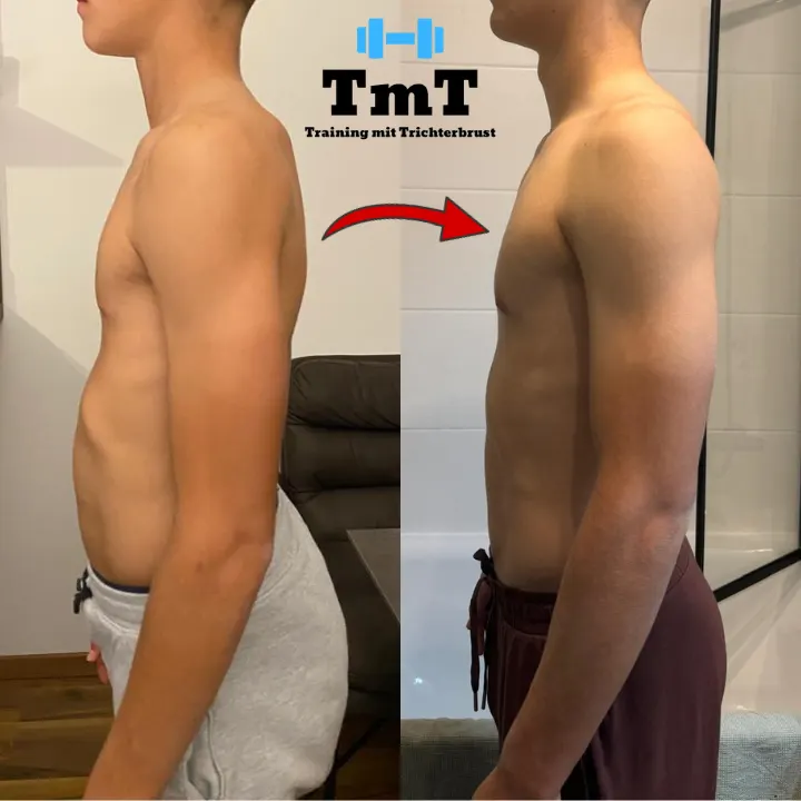 Training mit Trichterbrust — pt-studio in Hamburg — 5